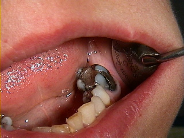 restaureren-gebit-tandartspraktijk-utrecht-voor-behandeling