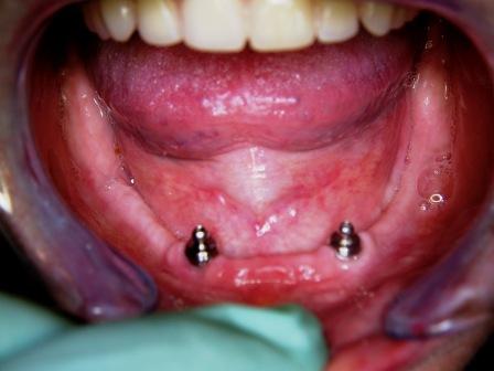 Implantologie-tandartsenpraktijk-utrecht
