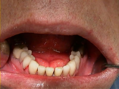 restaureren-gebit-tandartspraktijk-utrecht-na-behandeling